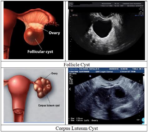 biopsy ovarian cyst|biopsy for ovarian cancer.
